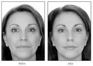 Facial rejuvenation before and after